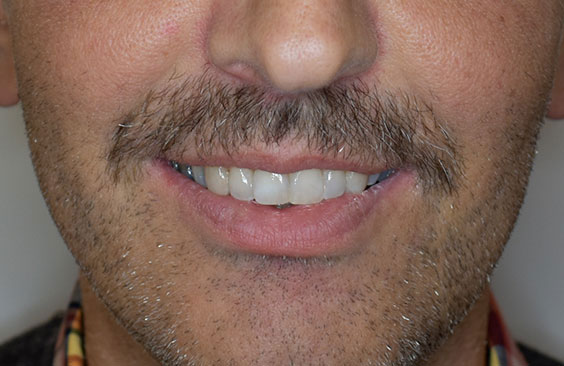 orthodontiki gia enilikes nikos spyropoulos orthodontikos