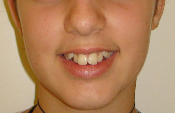 paidiko orthodontiko peristatiko prin nikos spyropoulos orthodontikos
